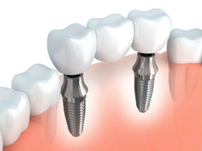 Implant Dentistry | Middlebury Dental Group | Dentist Watertown, CT