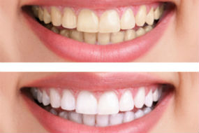 Teeth Whitening | Middlebury Dental Group | Middlebury Dentist