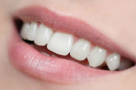 Porcelain Veneers | Middlebury Dental Group | Middlebury Dentist