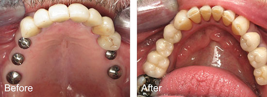 Middlebury Dental Group - Before & After Smile Gallery