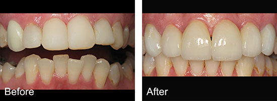 Middlebury Dental Group - Before & After Smile Gallery